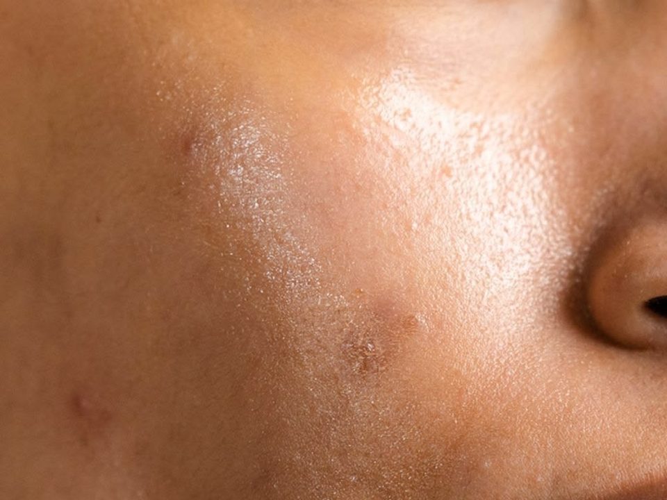 Gros plan d'une joue à la peau grasse avec de petites imperfections